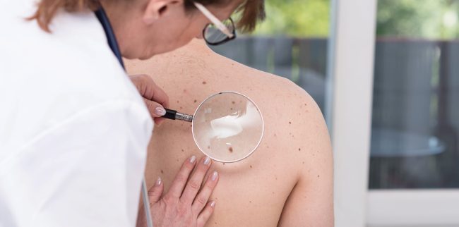 “Semear é Cuidar”, com foco em câncer de pele, será lançado na quarta-feira em Caconde